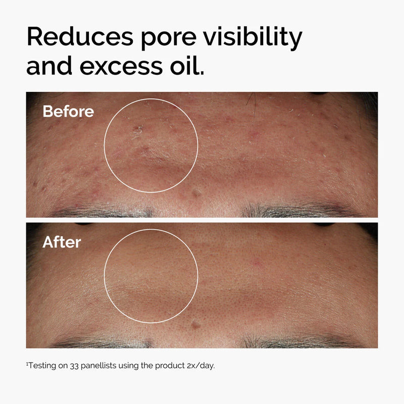 The Ordinary Niacinamide 10% + Zinc 1% Serum - Buy Online in Bangladesh | ePharma
