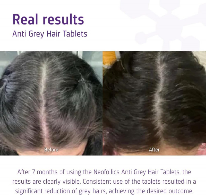 Neofollics Hair Growth Supporting 20 Tablets - Buy Online in Bangladesh | ePharma