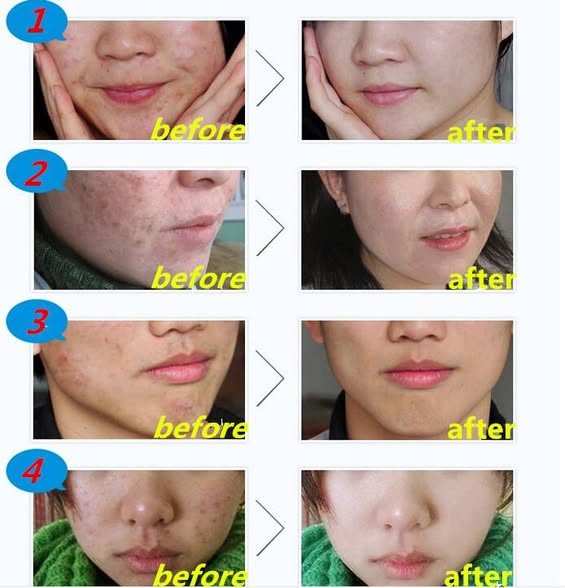 Bioaqua Pure Skin Acne Removal & Rejuvenation Cream 30g - Buy Online in Bangladesh | ePharma